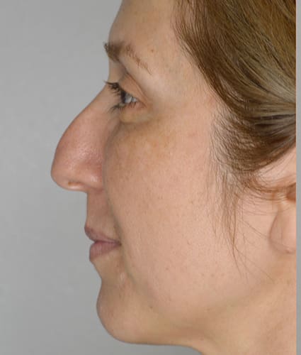 Rhinoplasty Case 35 – Before