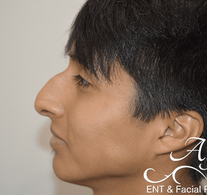 Rhinoplasty Case 22 – Before
