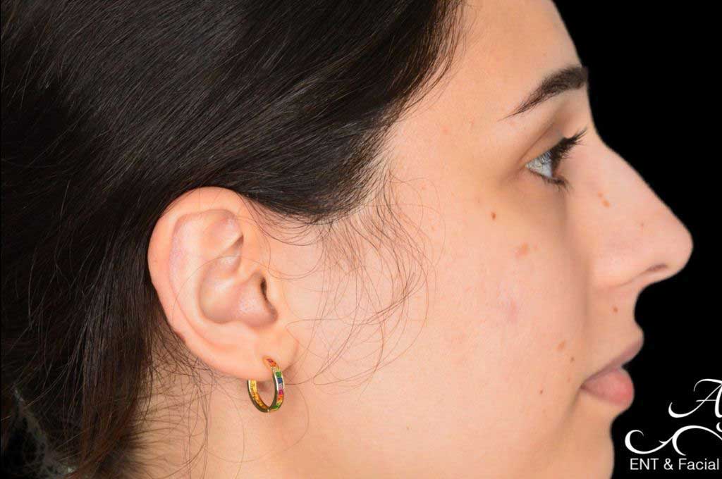 Rhinoplasty Case 41 – Before