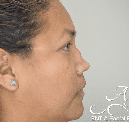 Rhinoplasty Case 23 – Before