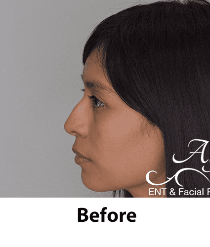 Rhinoplasty Case 24 – Before