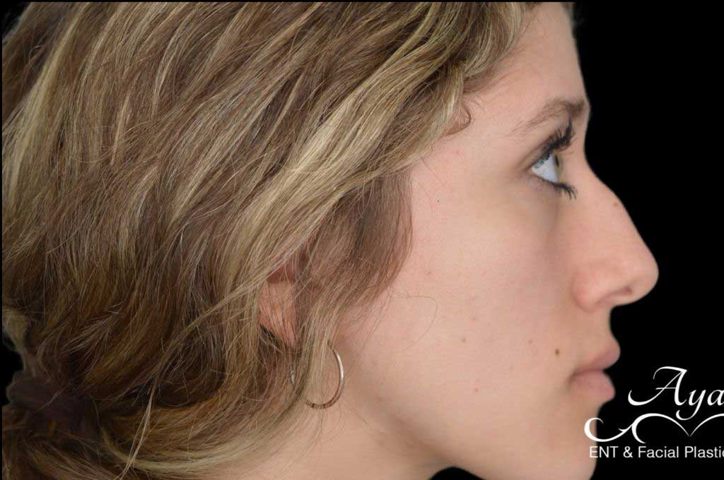 Rhinoplasty Case 43 – Before