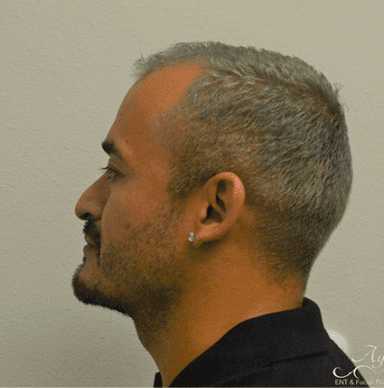 Rhinoplasty Case 4 – Before