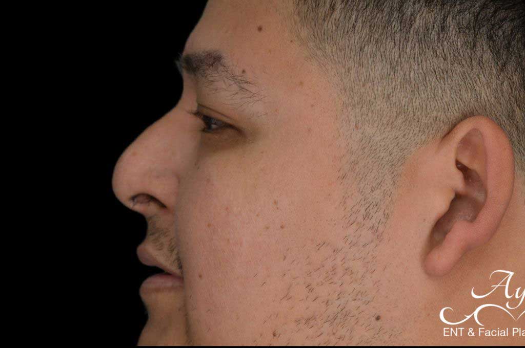 Rhinoplasty Case 51 – Before