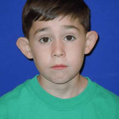 Ear Surgery Case 2 – Before
