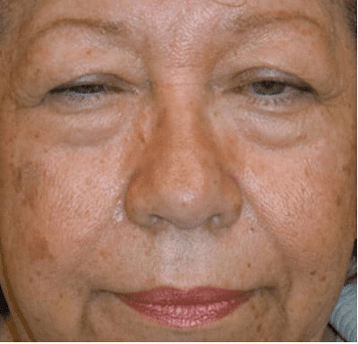 Eyelid Surgery Case 3 – Before