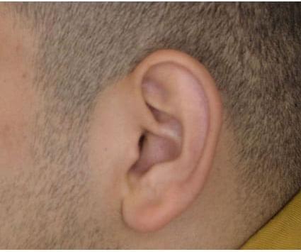 Ear Surgery Case 4 – Before