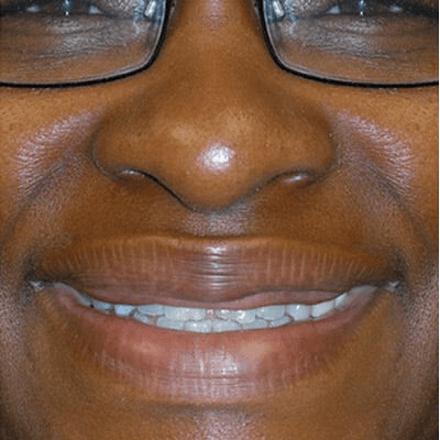 Lip Augmentation Case 2 – Before