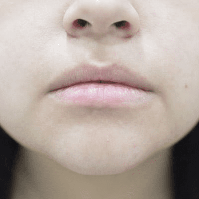 Lip Augmentation Case 3 – Before