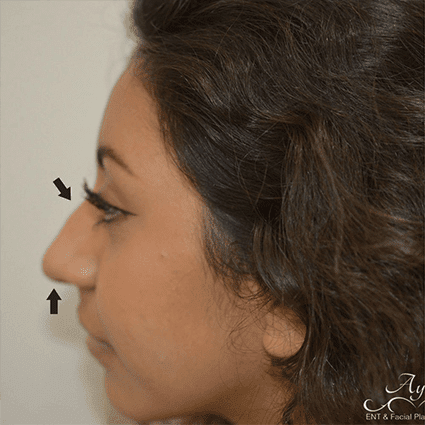 Rhinoplasty Case 13 – Before