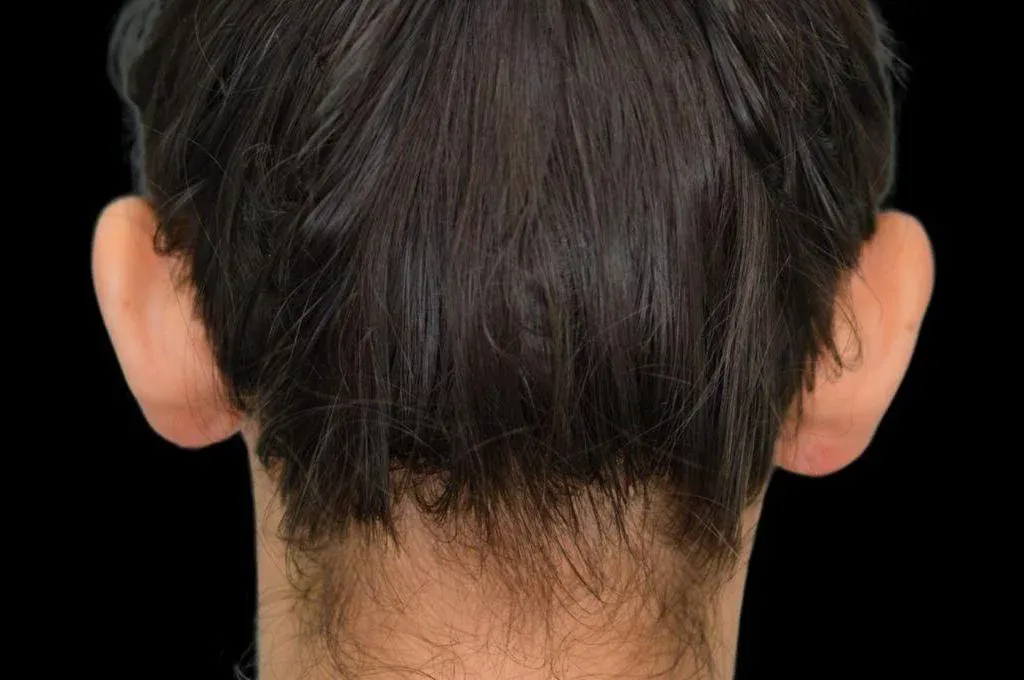 Ear Surgery Case 17 – Before