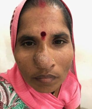Rhinoplasty Case 34 – Before