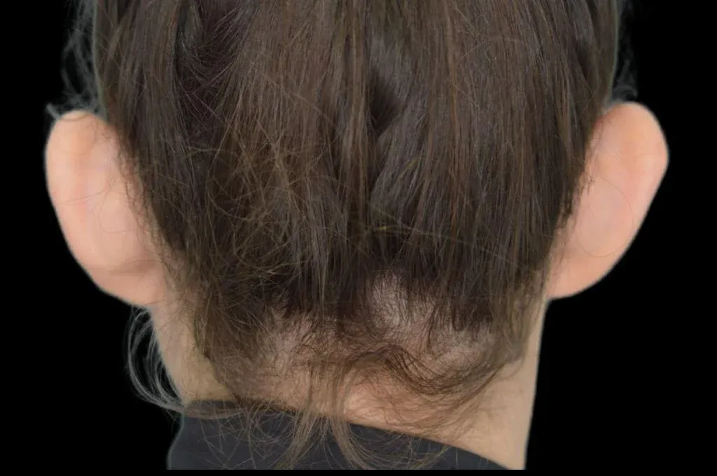 Ear Surgery Case 9 – Before