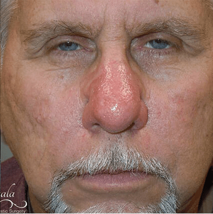 Rhinoplasty Case 19 – After