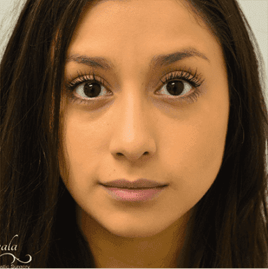 Rhinoplasty Case 2 – After