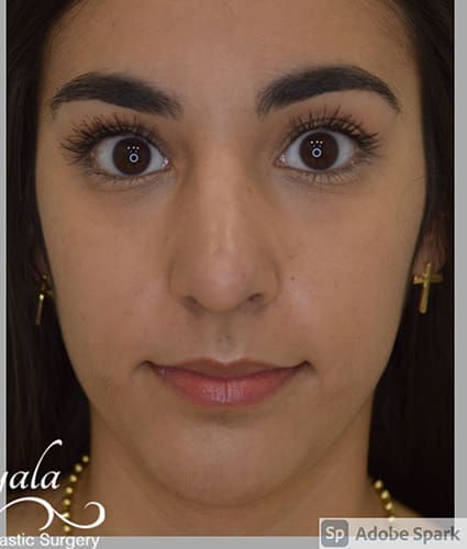 Rhinoplasty Case 38 – After