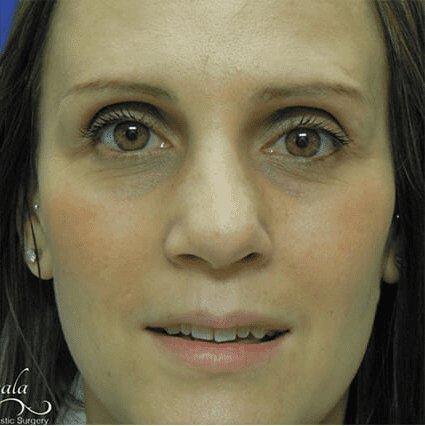 Rhinoplasty Case 21 – After