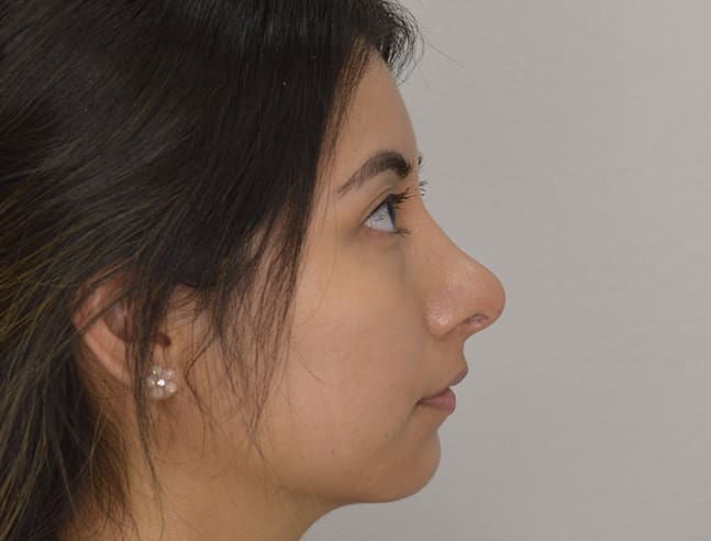 Rhinoplasty Case 40 – After
