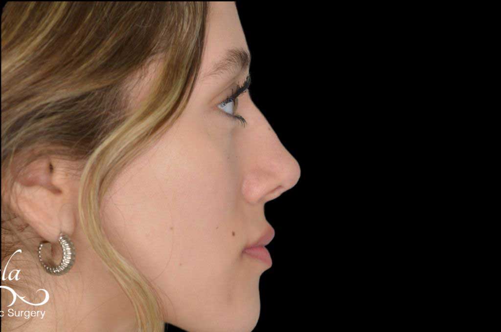 Rhinoplasty Case 43 – After