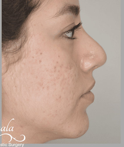 Rhinoplasty Case 37 – After