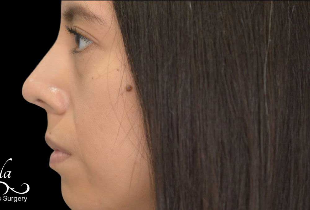 Rhinoplasty Case 45 – After