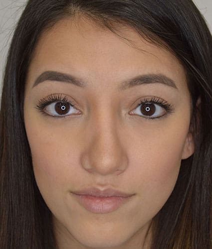 Rhinoplasty Case 27 – After