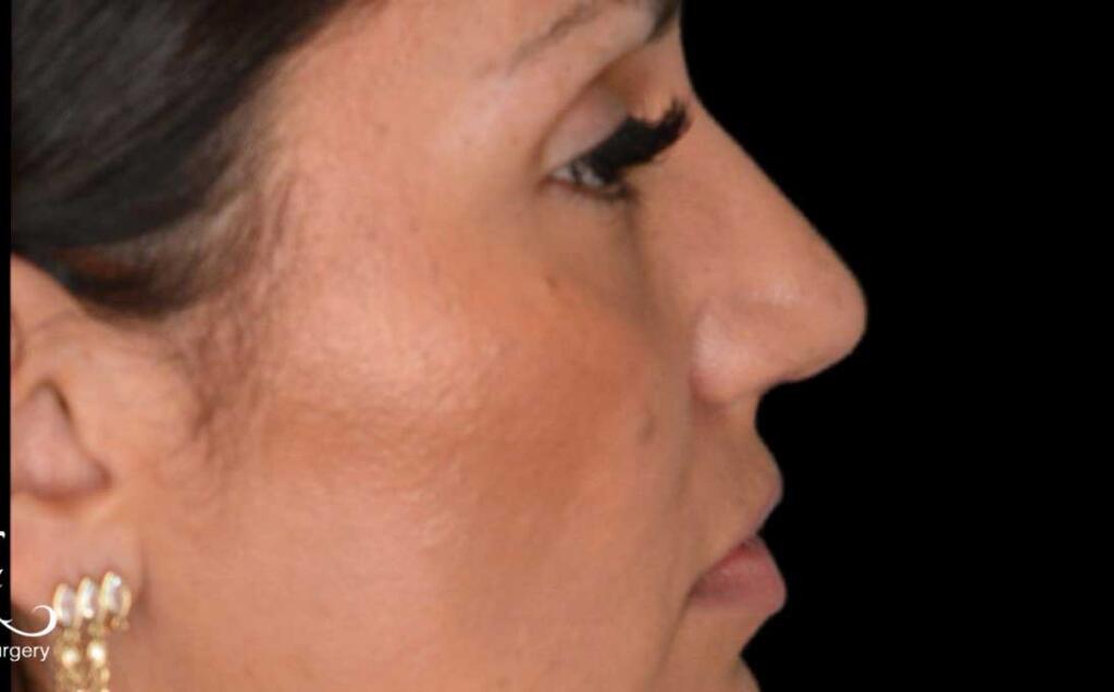 Rhinoplasty Case 48 – After