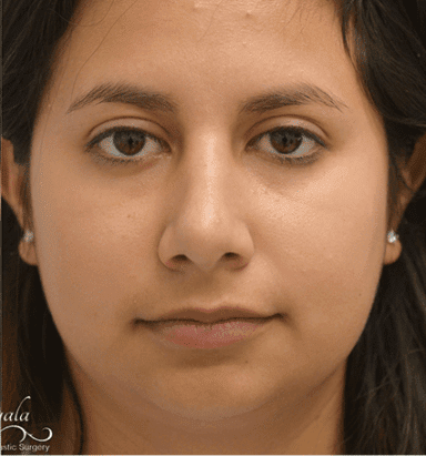 Rhinoplasty Case 7 – After