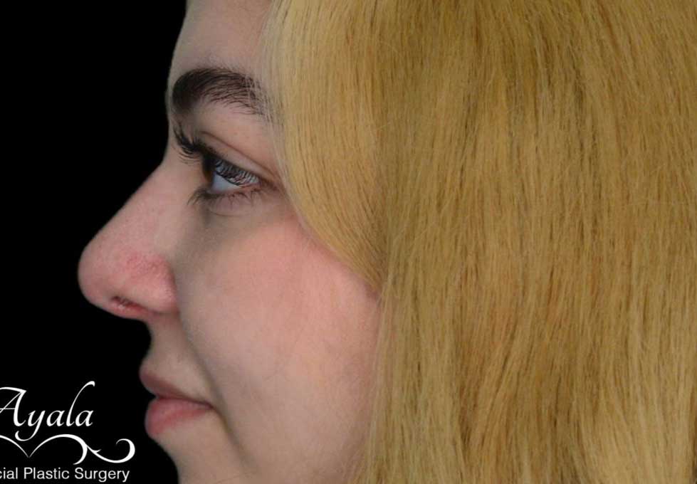 Rhinoplasty Case 50 – After
