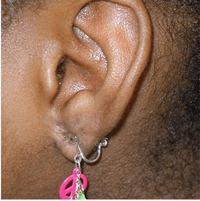 Ear Surgery Case 1 – After