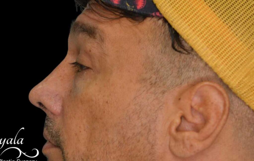 Rhinoplasty Case 53 – After