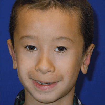 Ear Surgery Case 3 – After