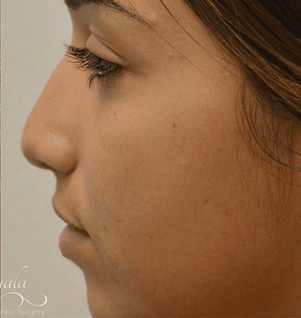 Rhinoplasty Case 12 – After