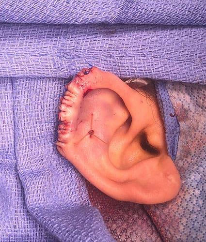 Ear Surgery Case 5 – After