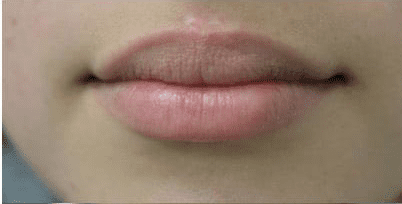 Lip Augmentation Case 1 – After