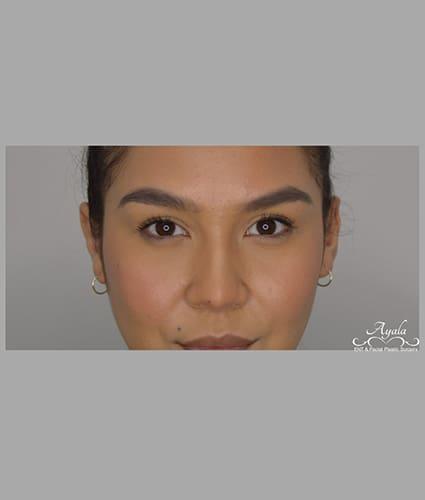 Ear Surgery Case 7 – After
