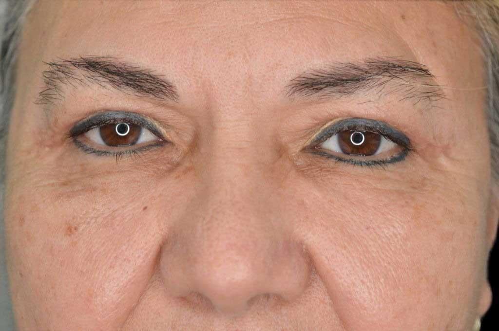 Eyelid Surgery Case 5 – After