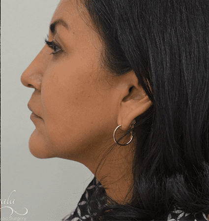 Rhinoplasty Case 14 – After