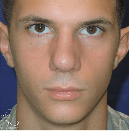 Rhinoplasty Case 17 – After