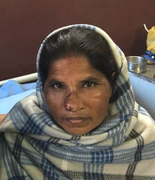 Rhinoplasty Case 34 – After