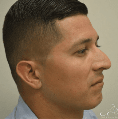 Rhinoplasty Case 10 – Before