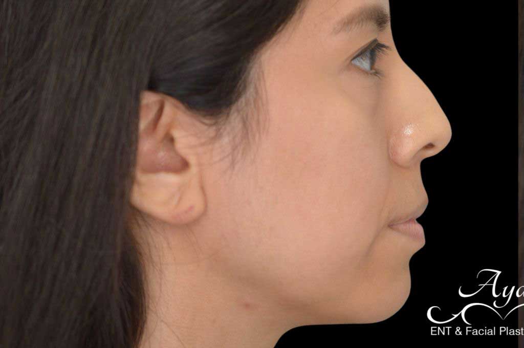 Rhinoplasty Case 45 – Before