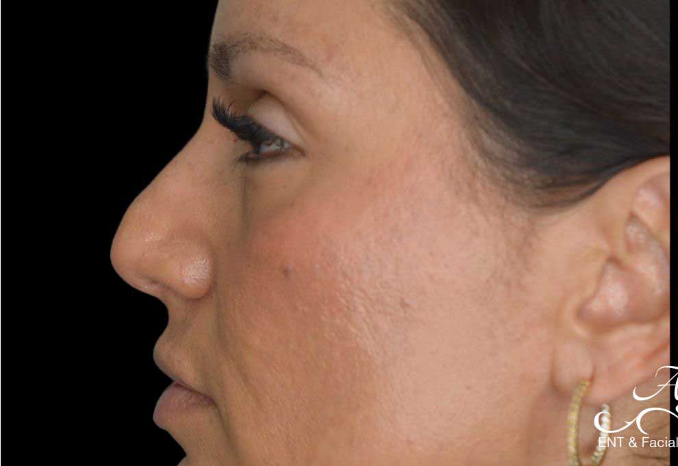 Rhinoplasty Case 48 – Before