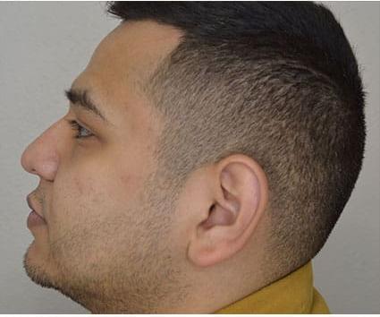 Ear Surgery Case 4 – Before