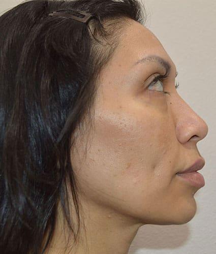 AccuTite Case 1 – Before
