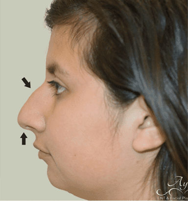 Rhinoplasty Case 7 – Before