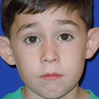 Ear Surgery Case 2 – Before