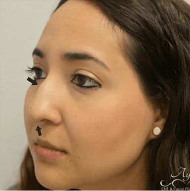 Rhinoplasty Case 1 – Before