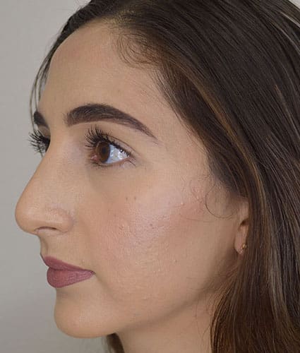 Rhinoplasty Case 26 – After
