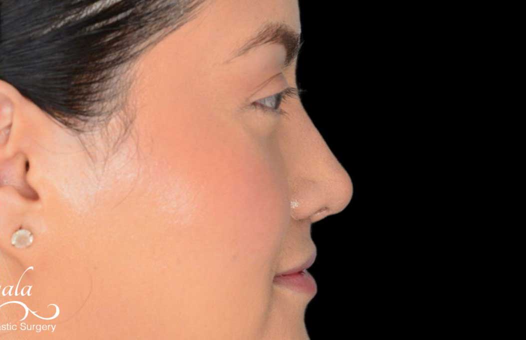 Rhinoplasty Case 52 – After